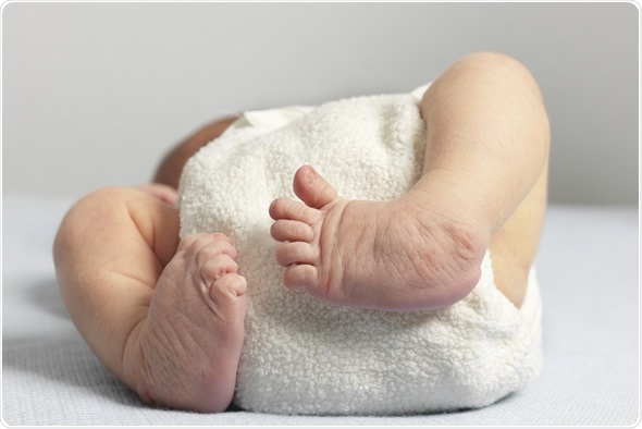 Newborn with bilateral club foot, also called congenital talipes equinovarus - Image Copyright: Alis Leonte / Shutterstock